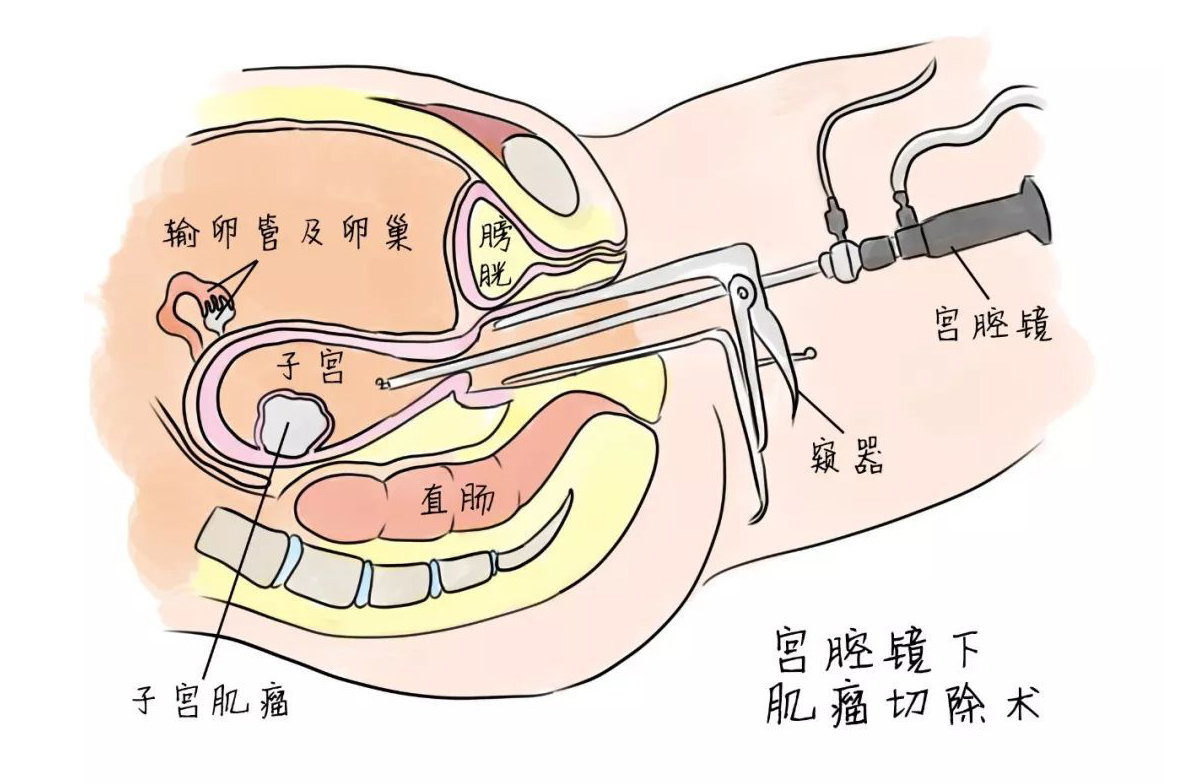 【宮腔鏡】宮腔鏡子宮肌瘤切除術 【宮腔鏡】宮腔鏡子宮肌瘤切除術