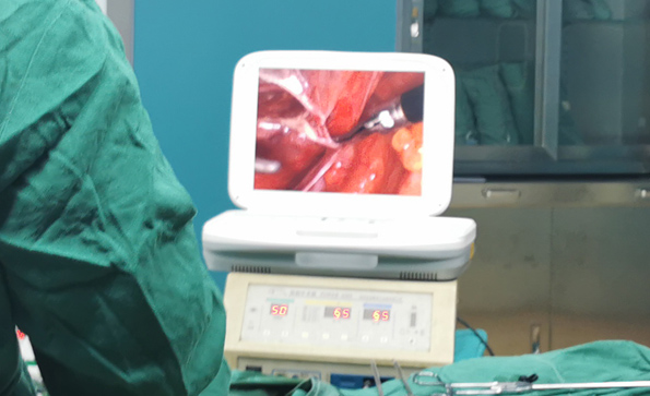 宮腔鏡和腹腔鏡有什么不同？